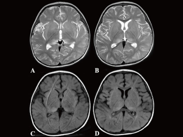 ONE IN 100 PATIENTS HOSPITALIZED WITH COVID-19 LIKELY TO DEVELOP NEUROLOGICAL COMPLICATIONS