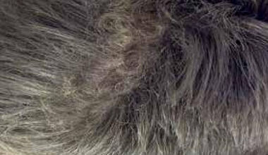 A Case of Woolly Hair with Dextrocardia and Situs Inversus 