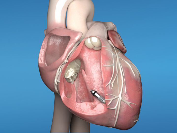 Micra leadless pacemaker shows fewer complications