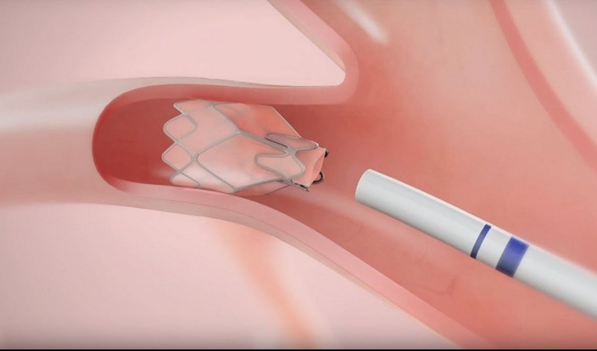 Zephyr endobronchial valves already reimbursed in Europe VIDEO Credo