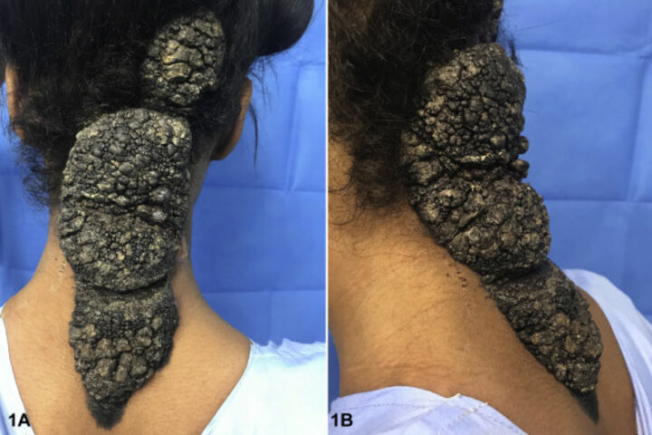 A disfiguring mass on the posterior aspect of the neck