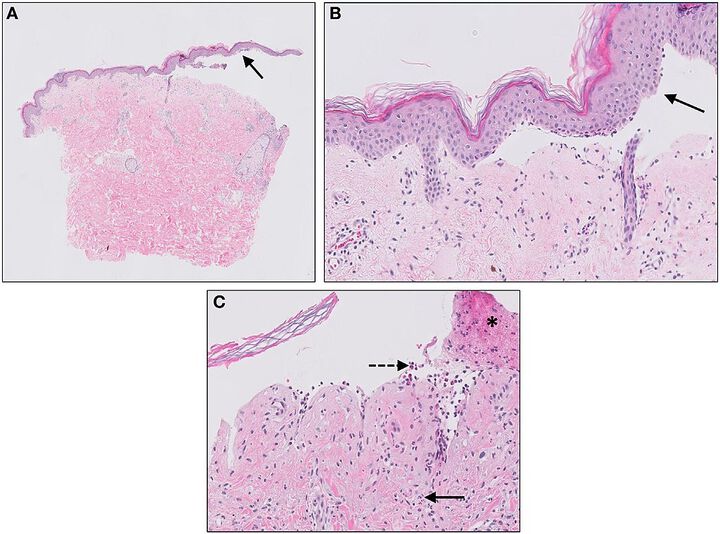 Recurrent Attack of Metformin Induced Bullous Pemphigoid