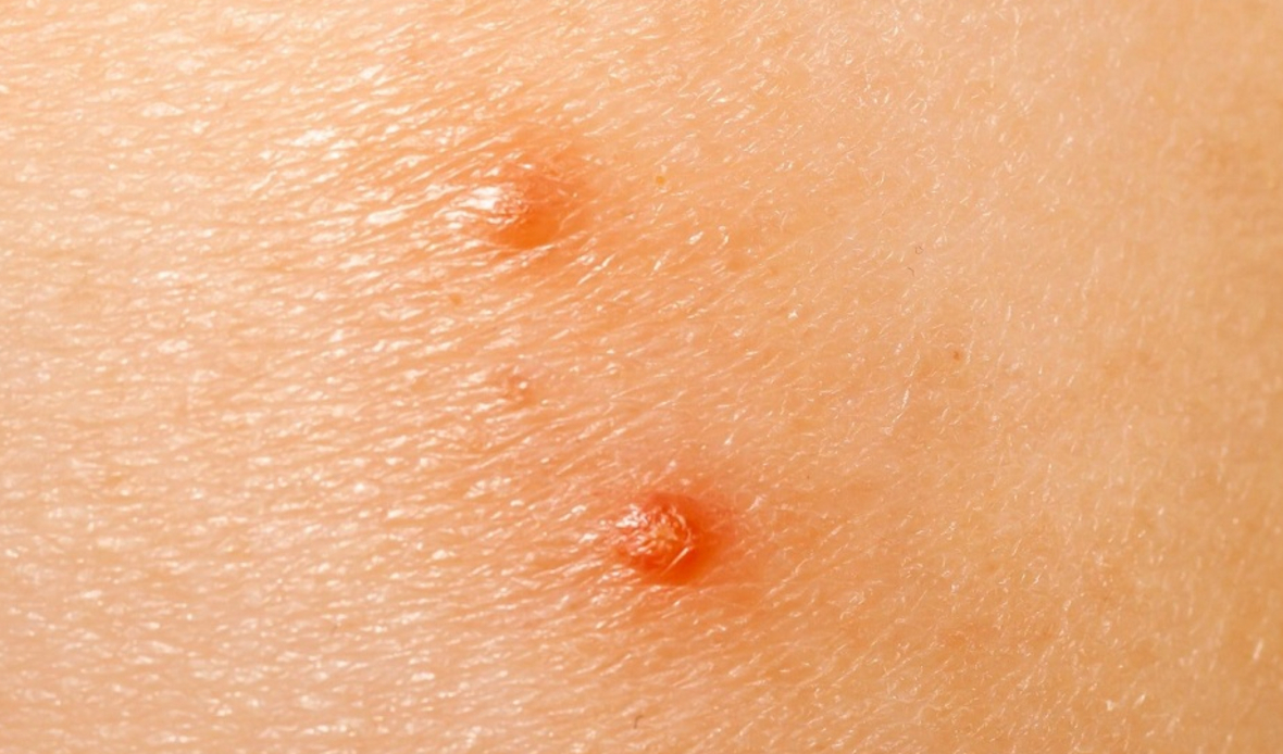 Molluscum Contagiosum - How To Stop Spreading It? | Credoweb