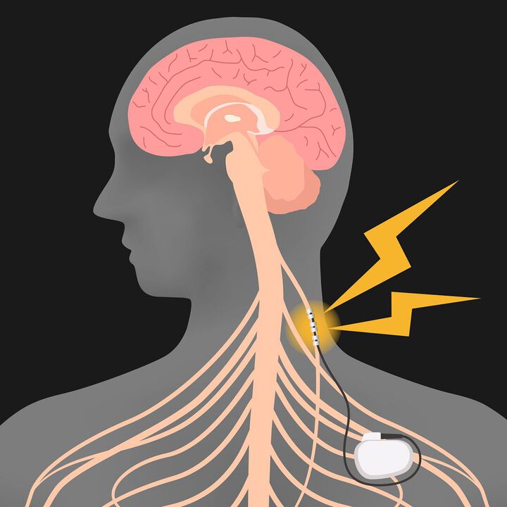  Effects of transcutaneous vagus nerve stimulation
