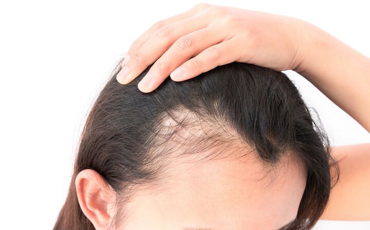 Hair loss in women