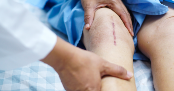 Surgeons not good at predicting benefit from knee operations