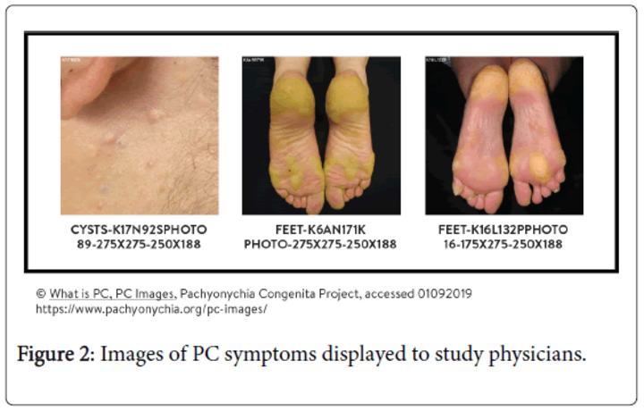 Prevalence of diagnosed/highly symptomatic pachyonychia congenita (PC) patients managed annually by US Dermatologists