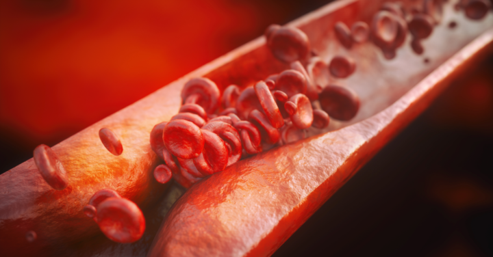 Biomarkers of Atherosclerosis: Is the Evaluation Essential Preoperatively?