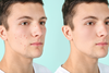 ACNE clinical guidelines