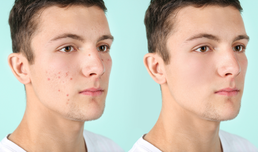 ACNE clinical guidelines