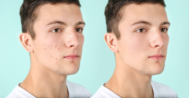 ACNE clinical guidelines