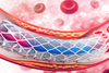 Stents no better than drugs for many heart patients