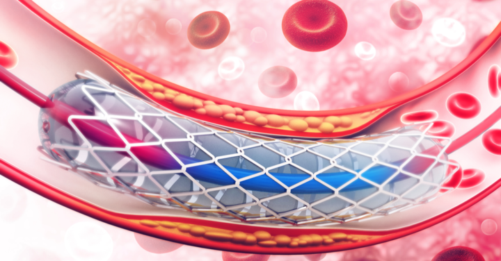 Stents no better than drugs for many heart patients