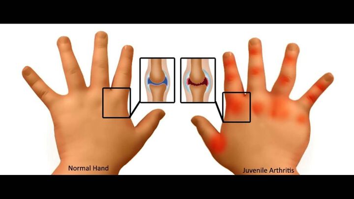 American College of Rheumatology/Arthritis Foundation Guideline for the Screening, Monitoring, and Treatment of Juvenile Idiopathic Arthritis–Associated Uveitis