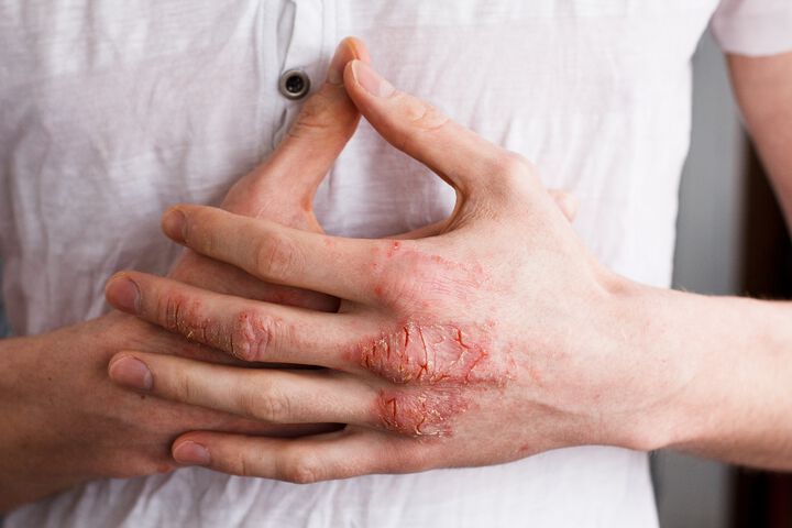 Psoriasis: In a War with Your Own Skin