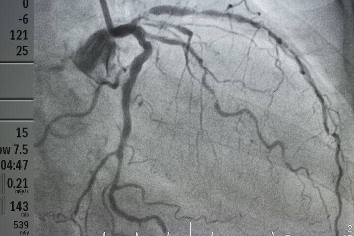 Prognosis of pulmonary embolism with right ventricular dysfunction