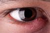 Ечемик в очите - причини и лечение