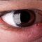 Ечемик в очите - причини и лечение