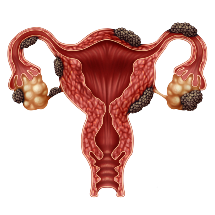 Endometrioseherde: Lokalisation