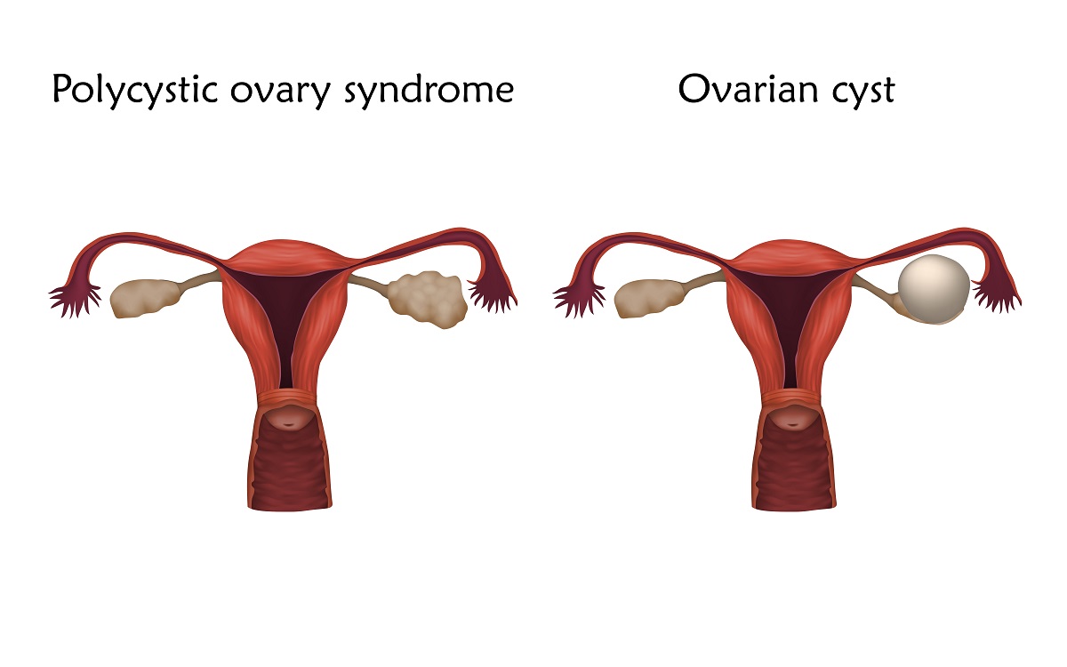 ovary cysts and polycystic ovaries