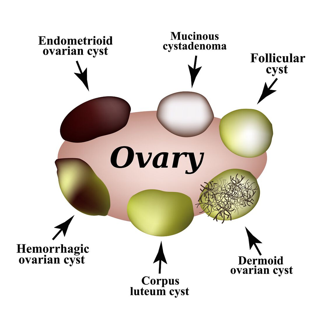 How Large Is A 4 Cm Cyst