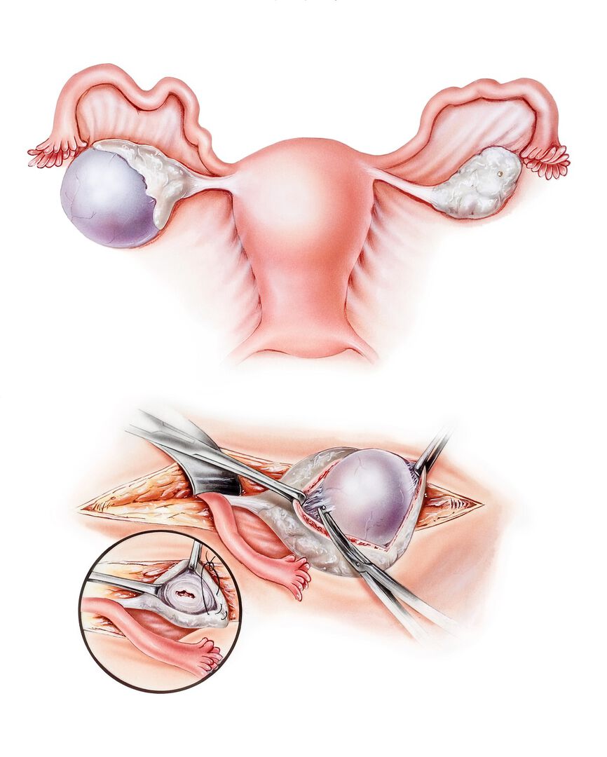 Follicular cyst, functional ovarian cysts, female reproductive system