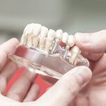 Имплантология и зъбни импланти