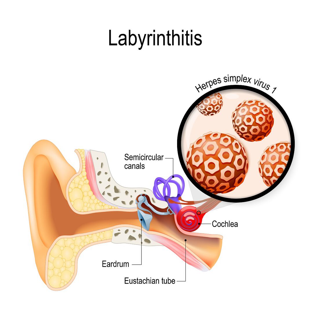 Labyrinthitis или vestibular neuritis
