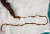 Детски хирурзи от УМБАЛ-Плевен извадиха топка с косми от стомаха на 12-годишна