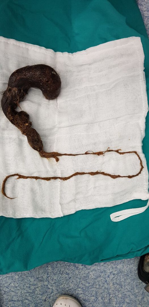 Детски хирурзи от УМБАЛ-Плевен извадиха топка с косми от стомаха на 12-годишна