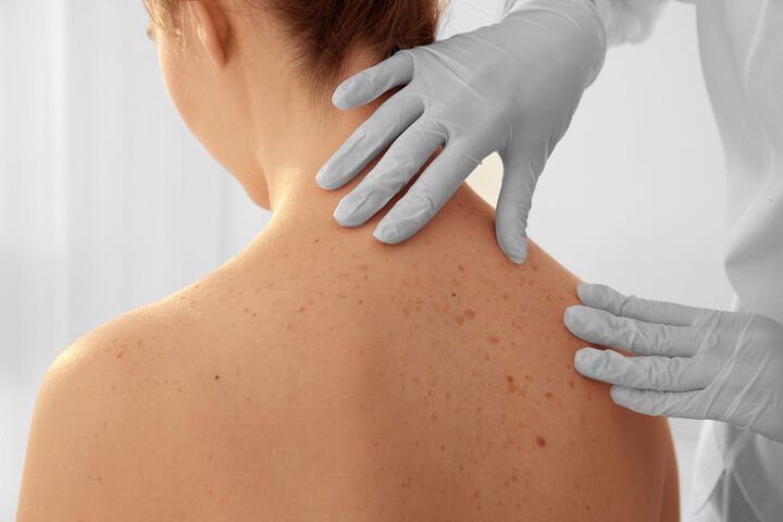 Безплатни прегледи за рак на кожата 