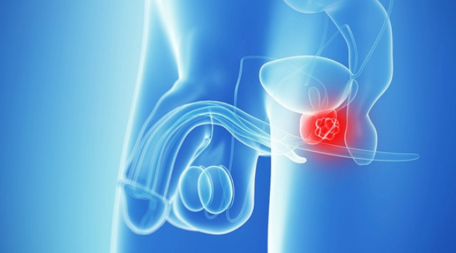Urologische Diagnostik des Prostatakarzinoms - Video
