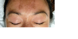 Novel Supplement with Phenolic Compounds for Treatment of Melasma: Double Blind Placebo Controlled Trial Safety and Efficacy Evaluation