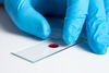 Allergie-Chip: Multiallergentest auch mit getrocknetem Blut möglich