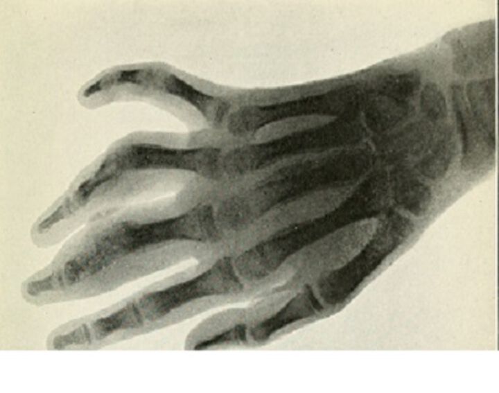 Advantages of MRI of bilateral hands in rheumatoid arthritis