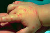 Жестоки комари след валежите пращат малчугани в детско отделение