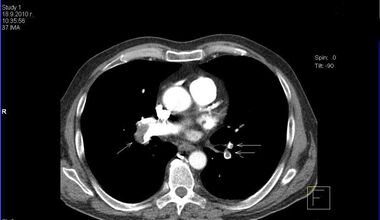 Submassive Pulmonary Embolism – A ‘Watch-And-Wait’ Strategy with Anticoagulation Alone or Advanced Therapy with Thrombolysis