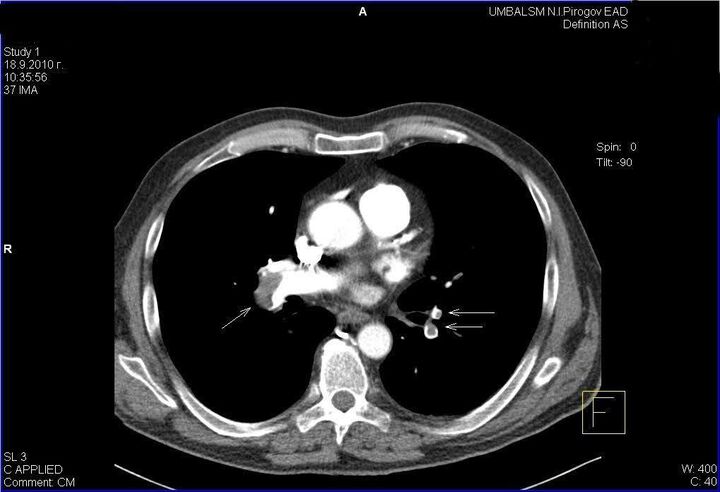 Submassive Pulmonary Embolism – A ‘Watch-And-Wait’ Strategy with Anticoagulation Alone or Advanced Therapy with Thrombolysis