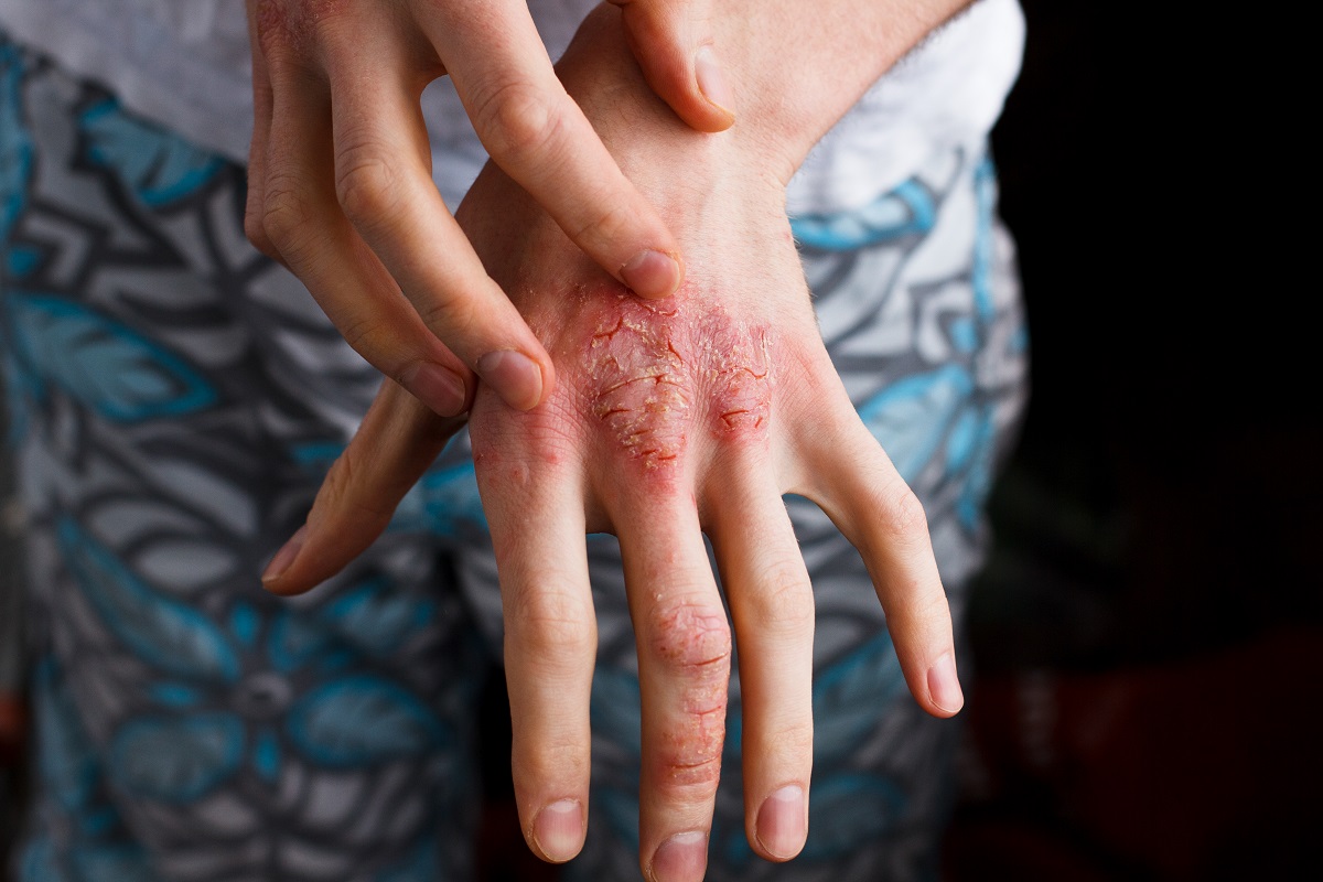 атопичен дерматит е незаразно възпалително кожно заболяване, което е хронично и рецидивиращо - в този примерен случая: невродермит - екзема по ръцете