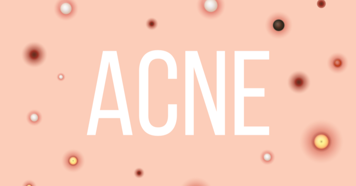 Human microbiome: An opportunity to develop novel treatments for acne vulgaris