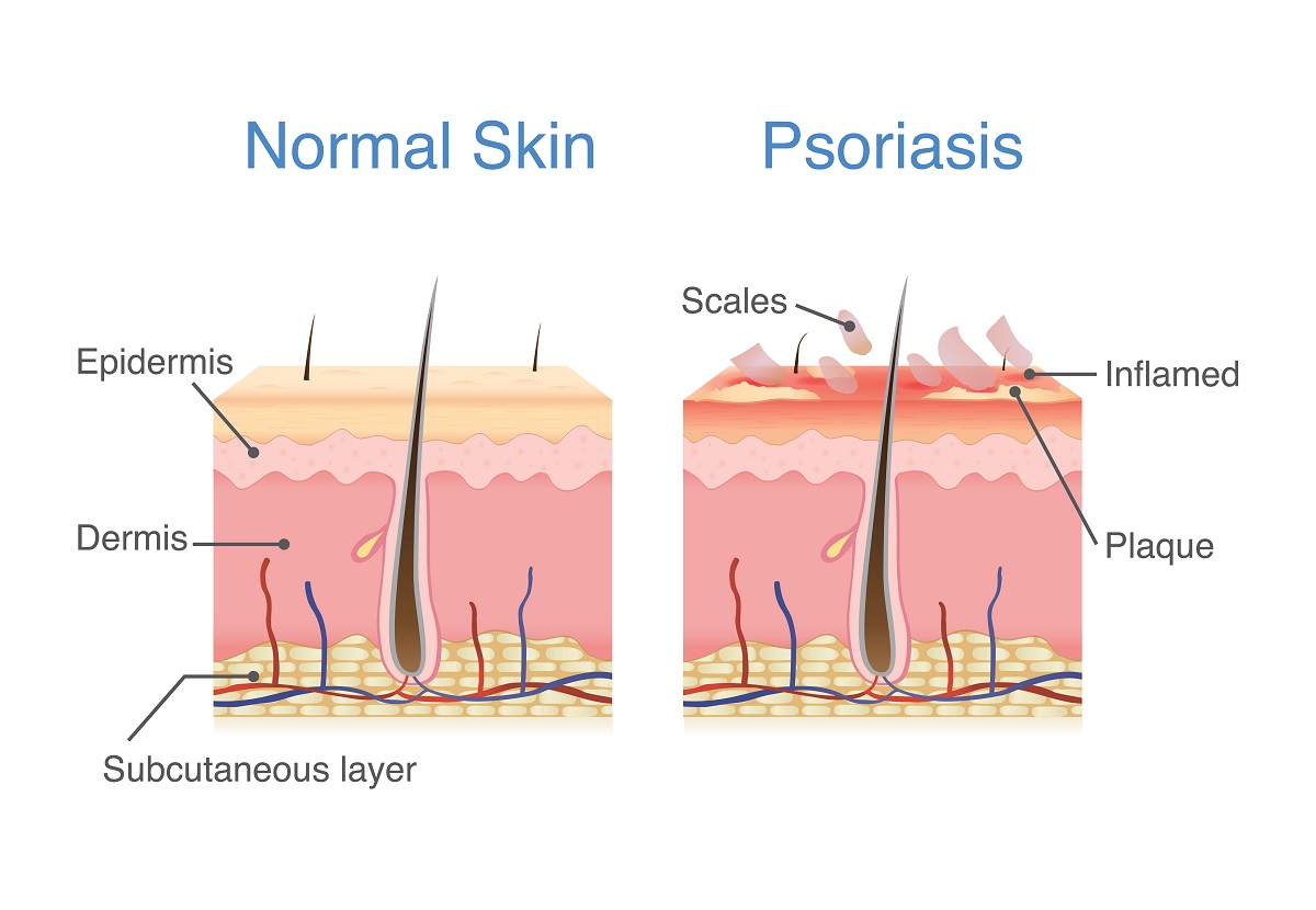 psoriasis formation