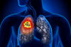 Lungenkrebs: Immuntherapie steigert das Gesamtüberleben