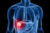 Leberkrebs: Neuer Biomarker für Leberversagen nach operativer Teilentfernung gefunden
