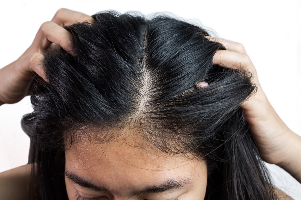 scalp psoriasis