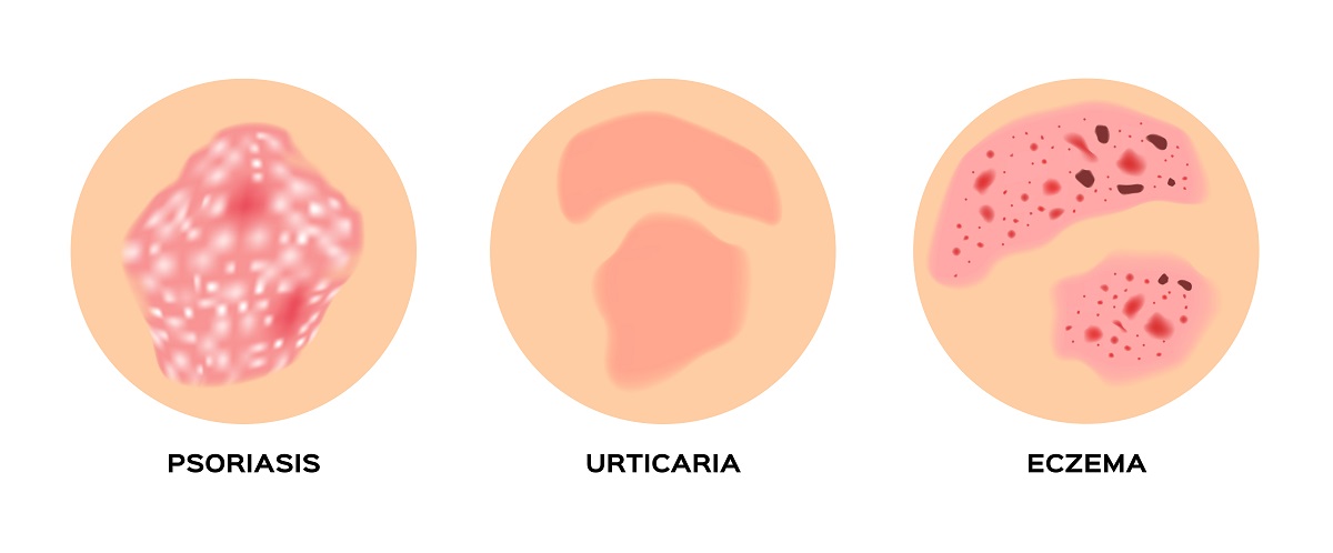 truth or lie about psoriasis