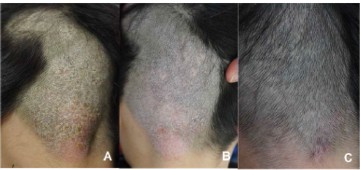 A Case of Localized Scalp Psoriasis Triggered by Microsporum canis Infected Tinea Capitis 