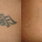 Премахване на татуировки с Ndyag лазер