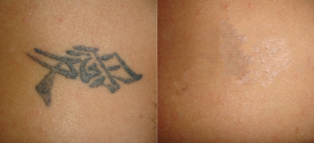 Премахване на татуировки с Ndyag лазер