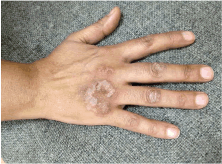 Case report of rare estrogen dermatitis