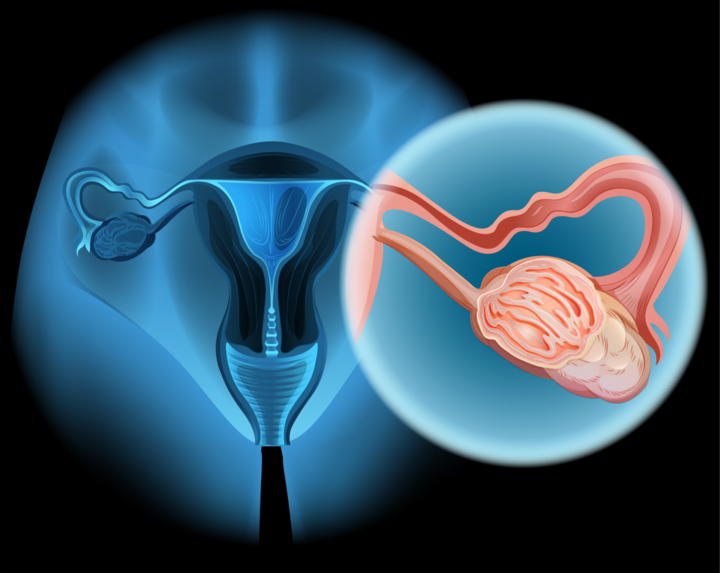 Ovarian cancer: no sure methods of early detection